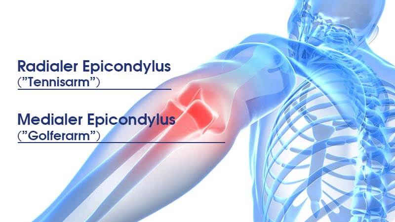 Schaubild radialer epicondylus und medialer epicondylus