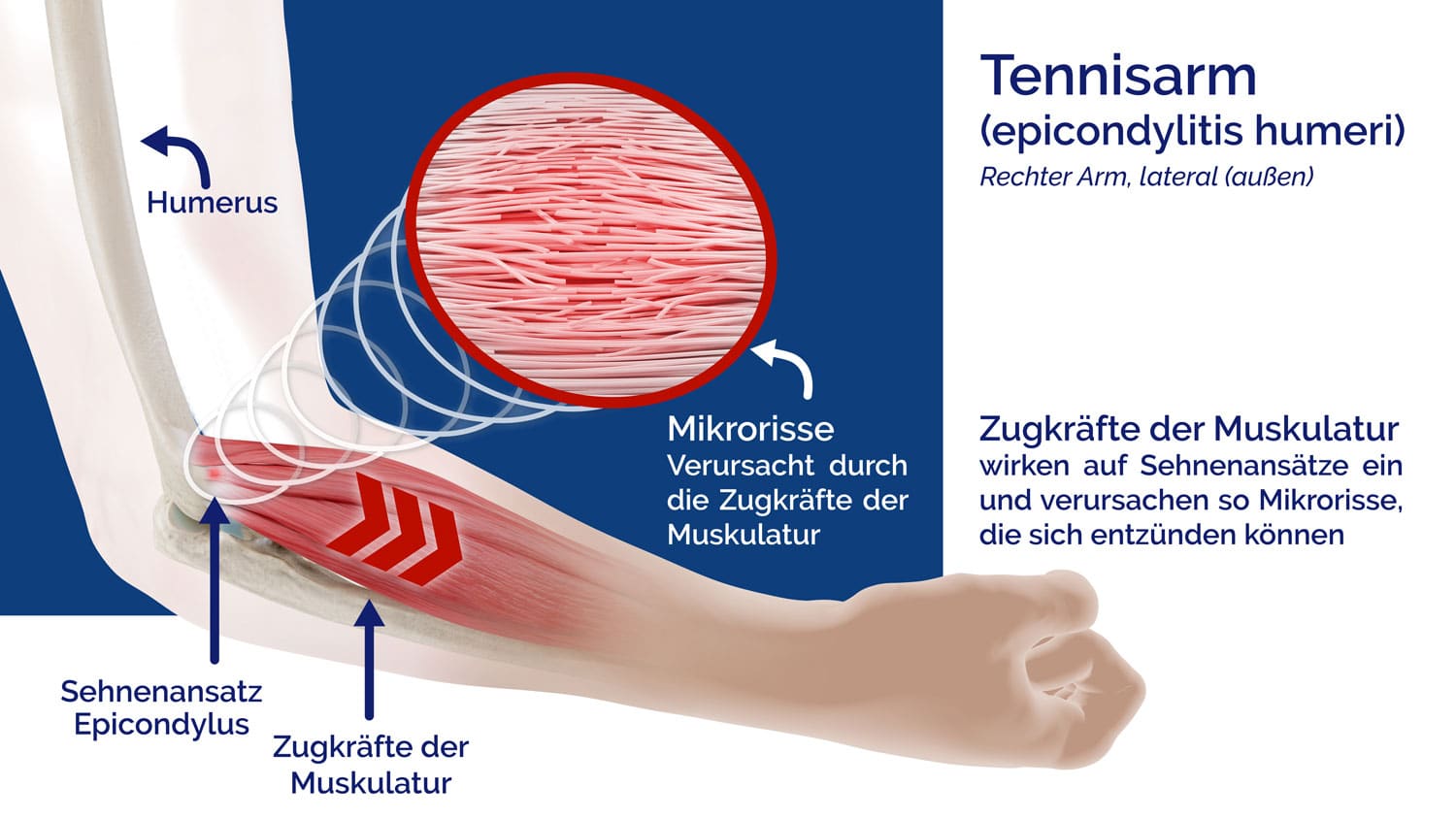 Schaubild Ursache der Epicondylitis, Tennisarm, Golferarm der Masalo KG