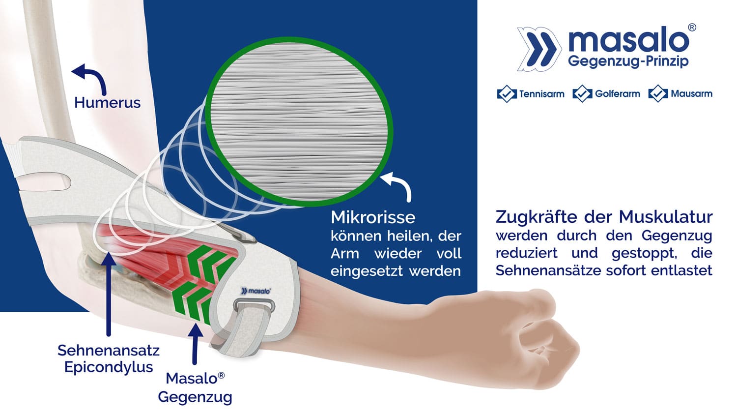 Schaubild Gegenzugprinzip der Masalo Manschette gegen Tennisarm, Golferarm, Mausarm, Epicondylitis