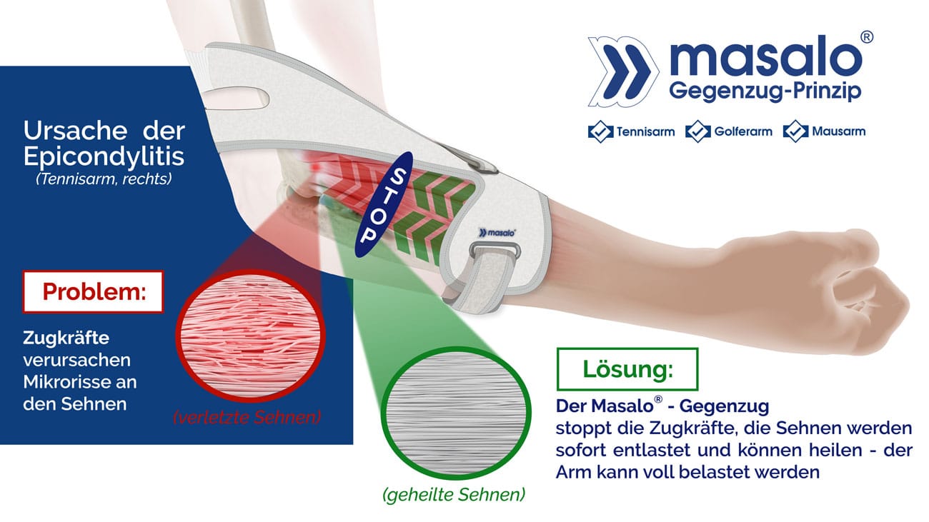 Schaubild Gegenzug-Wirkprinzip der Masalo Manschette gegen Tennisarm, Golferarm, Mausarm