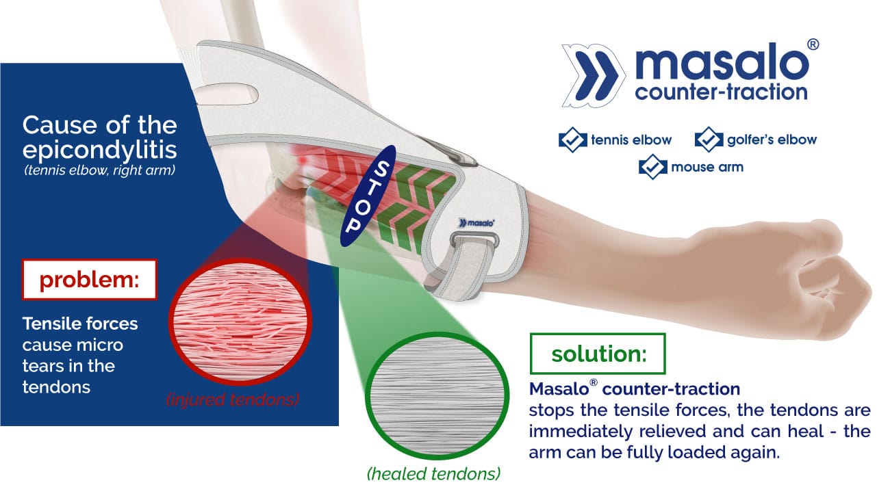Diagram of the principle of counteracting action of the Masalo cuff against tennis elbow, golfer's elbow, mouse elbow