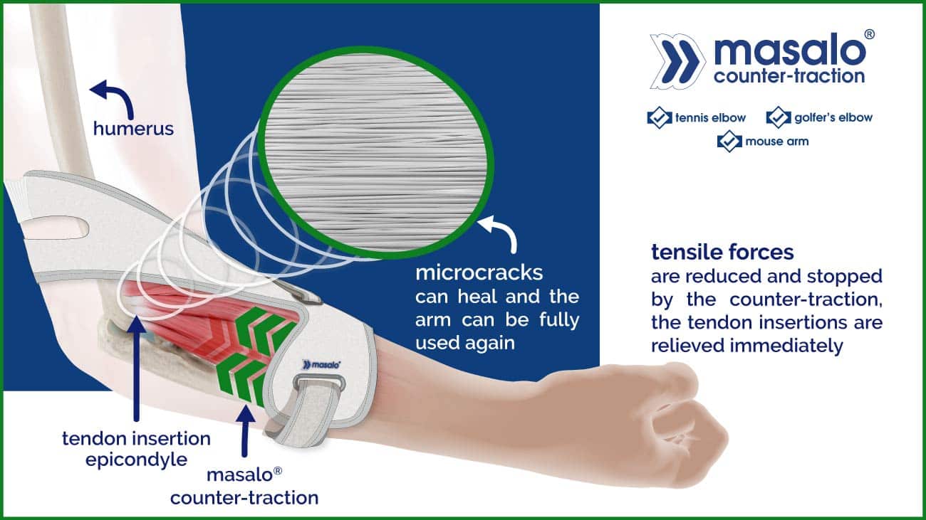 ghk-cu tennis elbow | Golfer's Elbow | DeQuervain's Tennis Elbow Rehab - E3