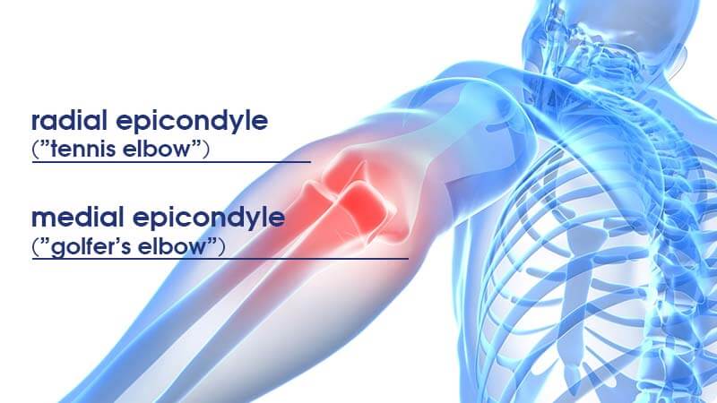 Diagram of radial epicondyle and medial epicondyle