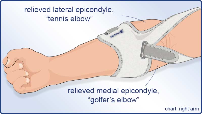 Diagram showing the Masalo Cuff MED and the pain relief with tennis elbow
