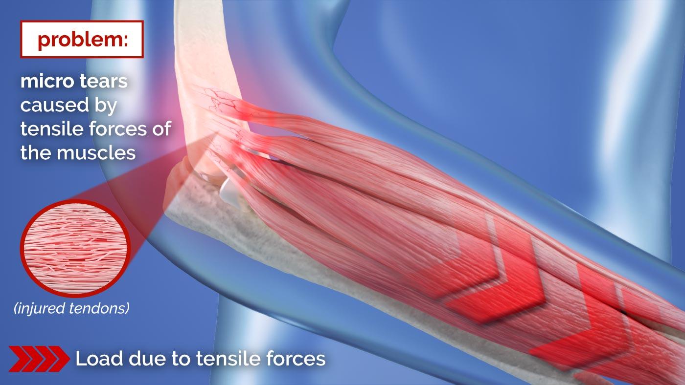 Illustration of how tensile forces cause epicondylitis
