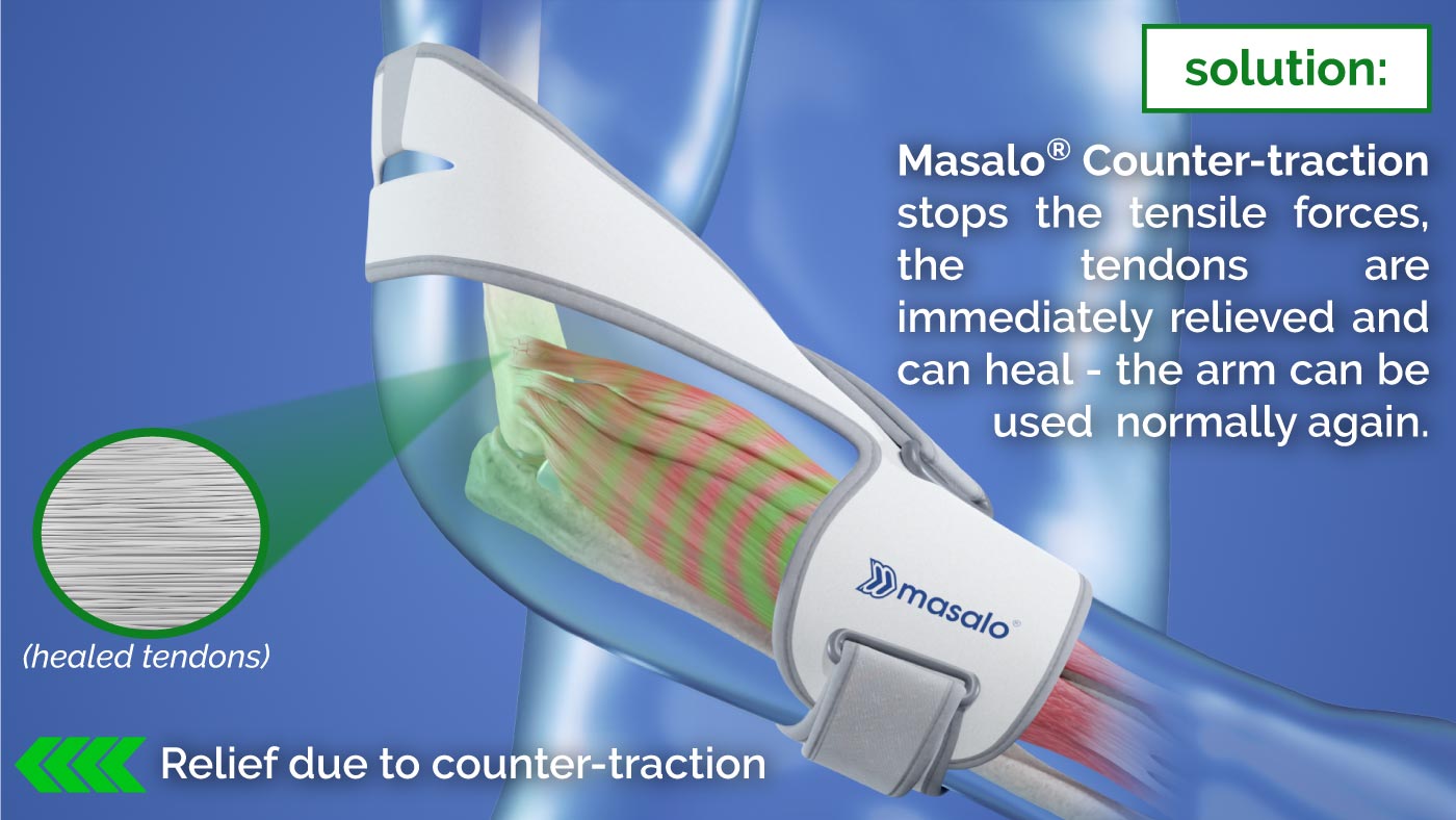 How the Masalo Cuff for tennis elbow and golfer's elbow works with counter traction principle